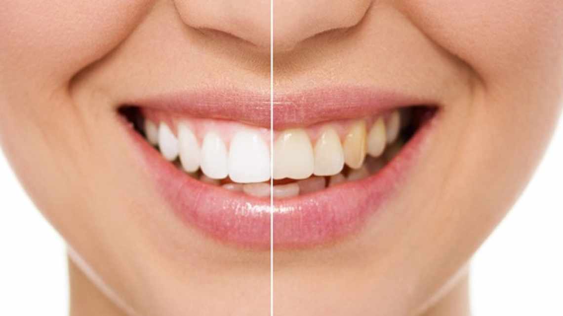 Реставрация зубов: вернуть красоту и здоровье улыбке